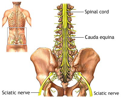 Chronic Pain of Sciatica